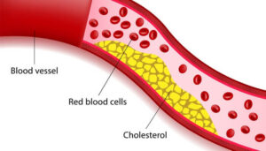 Cholesterol
